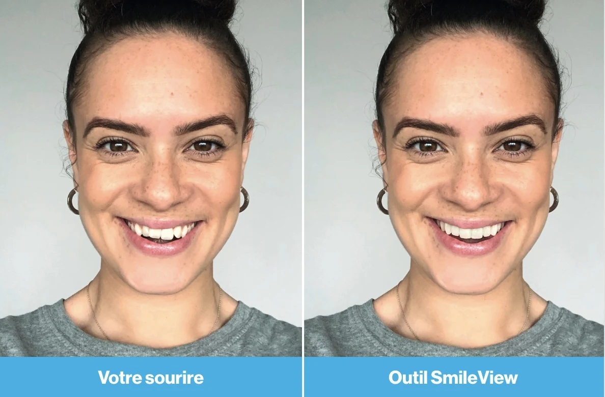 Exemple officiel de simulation avant et après avec Invisalign SmileView